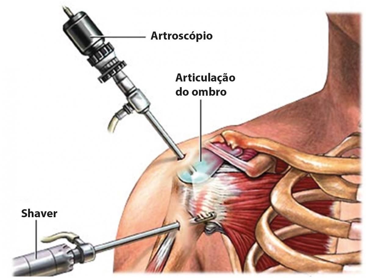 Cirurgia artroscópica no ombro Imagem