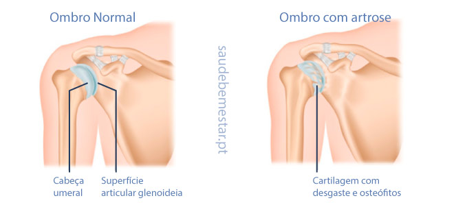Tratamento para artrose no ombro Imagem